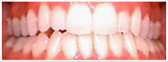 invisalign: before and after - crowding - after