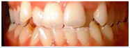 invisalign: before and after - crowding - before