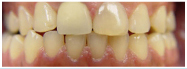 invisalign: before and after - spacing - after